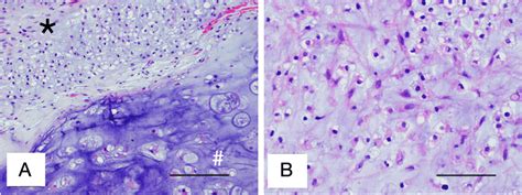 A Histopathologic Picture Of Excised Tissue With Hematoxylin And Eosin