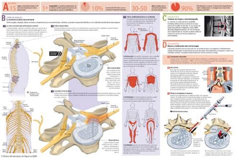 Hernia Discal L5 S1 Qué Es Causas Síntomas Y Tratamiento Images And Photos Finder