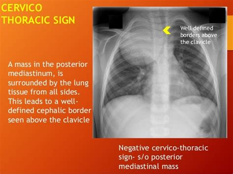 Mediastinal mass