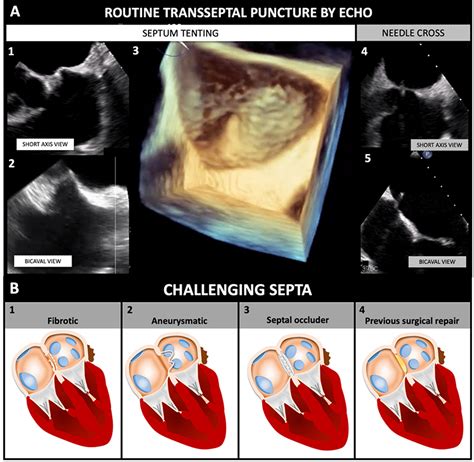 Transseptal Puncture Review Of Anatomy Techniques Complications And