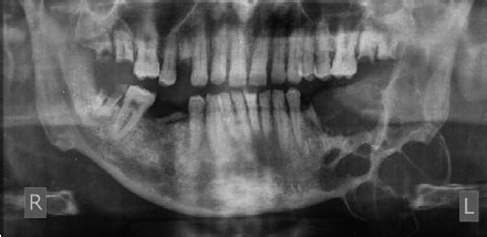 Panoramic Radiograph Showing An Ill Defined Multilocular Radiolucency