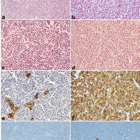 A Negative Bcl Immunostaining X C Moderate Bcl