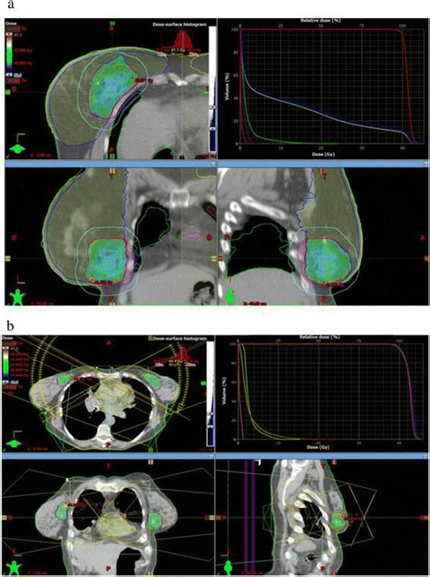 Typical Dosimetric Results Obtained With Accelerated Partial Breast