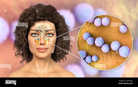 Streptococcus Mutans Bacteria As A Cause Of Sinusitis Computer Illustration Showing