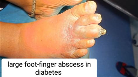 large foot finger abscess in diabetes patient | debridement | drainage ...