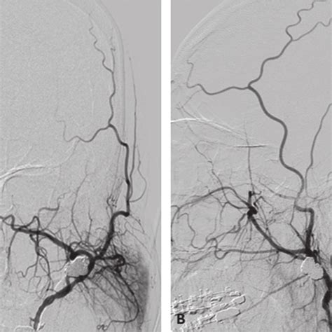 Preoperative Left External Carotid Angiogram Shows Two Aneurysms And An