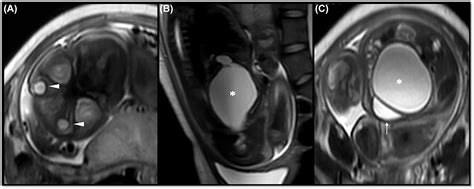 Prenatal Hydrometrocolpos As An Unusual Finding In Fraser Syndrome Case Report