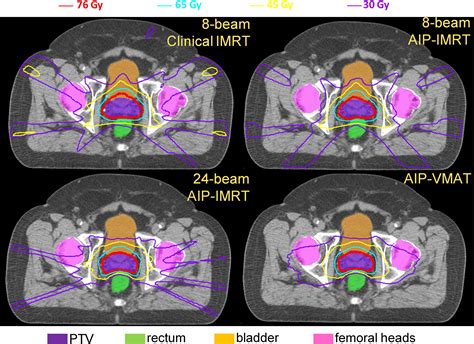 A Comprehensive Comparison Of Imrt And Vmat Plan Quality For Prostate