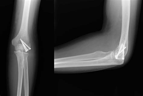 Supracondylar Ridge Of Humerus