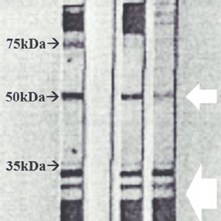 Positive Western Blot Result Of The Case Patient Western Blot Analysis