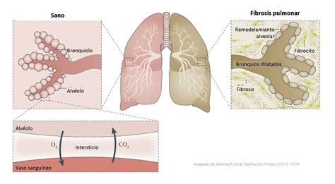 Enfermedad Pulmonar Intersticial Asociada A Porn Sex Picture