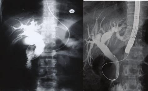 Ercp Showing Dilated Bile Ducts Without An Obstructive Cause Sickle Download Scientific