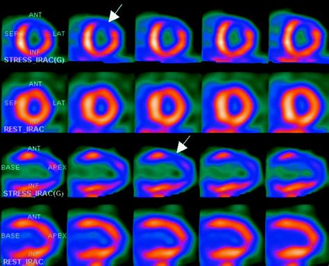 Hybrid Cardiac Single Photon Emission Computed Tomography Computed