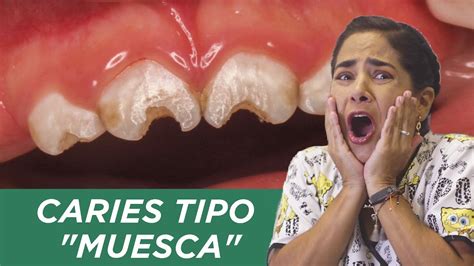 Caries Tipo Muesca YouTube