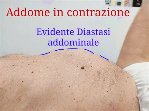 Diastasi addominale uomo e donna cos è rimedi trattamenti