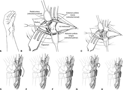 Description And Outcomes Of A New Technique For Thumb Basal Joint Arthroplasty Journal Of Hand