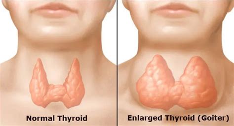 Nontoxic Multinodular Goiter Biocertica