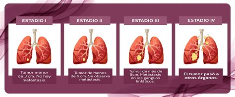 Cáncer de pulmón causas síntomas diagnóstico y tratamiento Samay Vida