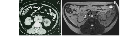 Ct Shows Retroperitoneal Soft Tissue Attenuating Lesion Asterisk That Download Scientific