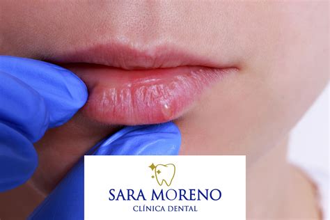 El Herpes Labial Causas S Ntomas Y Como Tratarlo