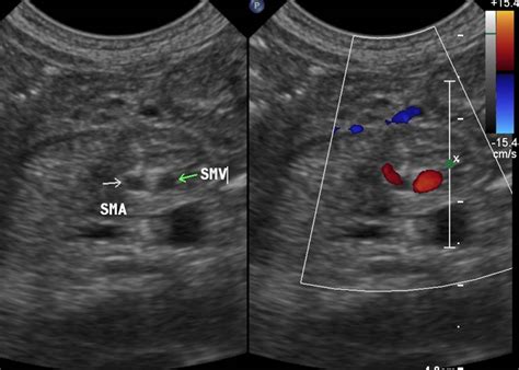 Malrotation Radiology Cases