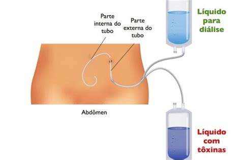 Hemodi Lise O Que Como Funciona E Poss Veis Riscos Tua Sa De