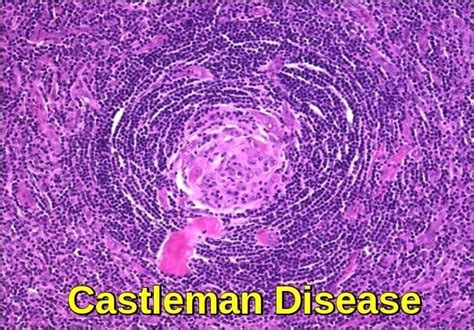 Castleman Disease Ask Hematologist Understand Hematology