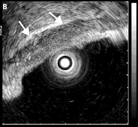 Endoscopic Ultrasonography Imaging And Beyond Gut