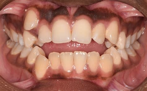 Before After Photos Blackburn Orthodontics Specialist Clinic