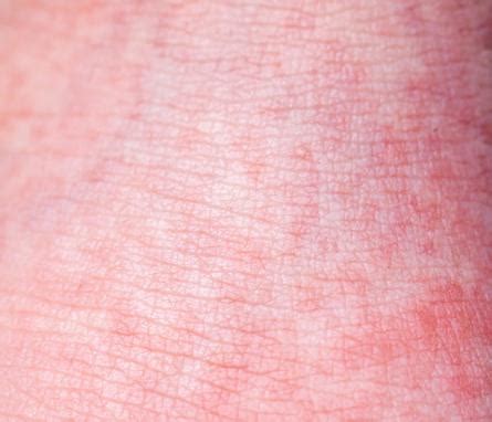 viral exanthem treatment reading  symptoms treatments derma