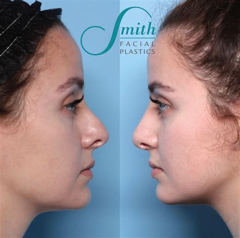 Rhinoplasty Columbus Oh Best Nose Surgery In Columbus