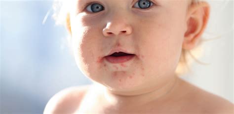 Skin Lesions On The Infant And Baby Skin Sanosan