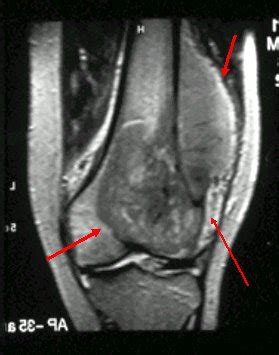 Tumor de células gigantes clínica Medwave