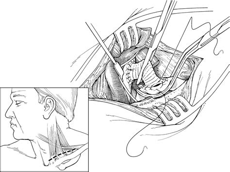 Figure 1 from Contemporary relevancy of carotid-subclavian bypass ...