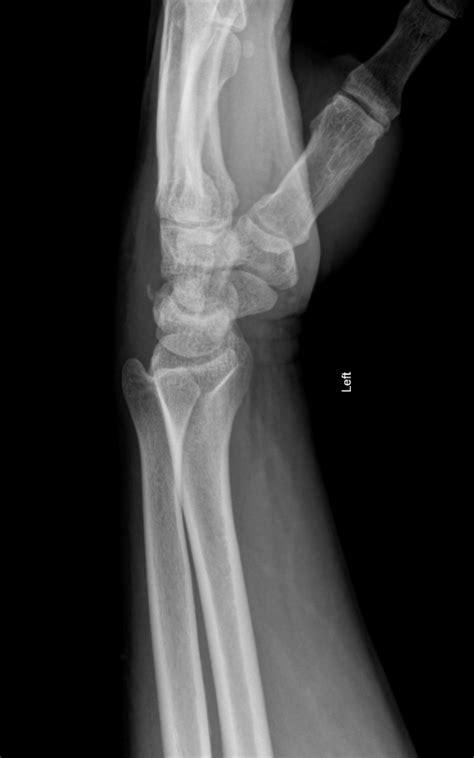 Triquetral Fracture Image