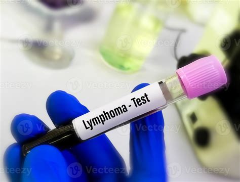 does lymphoma show up in blood work 2