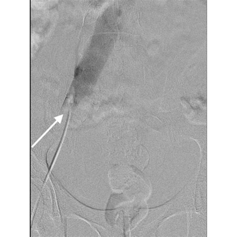 Venogram confirming an occluded external iliac vein (white arrow ...