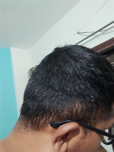 Longest Time Oral Minoxidil Users Please Check In R Tressless