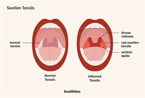 Swollen Tonsils: Tonsillitis, Symptoms, Causes, and More