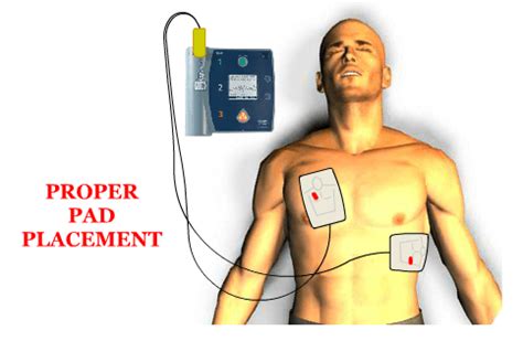 Aed Pad Placement Anteroposterior