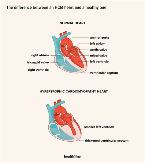 What Is Left Ventricular Hypertrophy Lvh American Heart Off