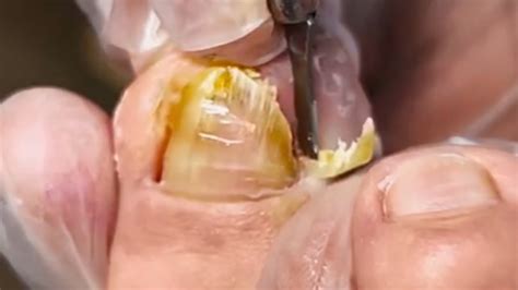 Ingrown Nails Trim Off Se Cortan Las U As Encarnadas Youtube