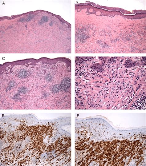 Balanitis Xerotica Obliterans Histology