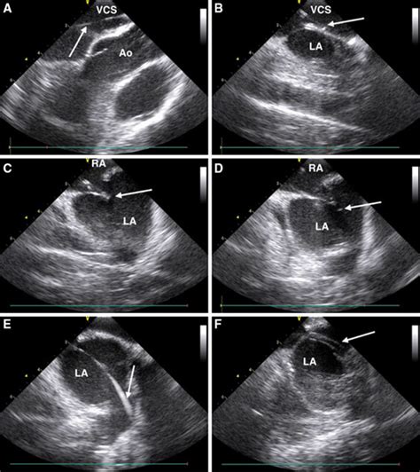 Intracardiac Echocardiography ICE Images Af Taken During The