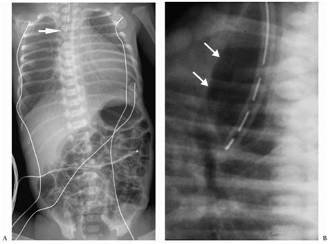 Esophagus And Gastrointestinal Tract Radiology Key