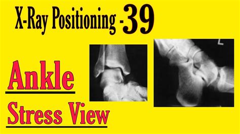 Ankle Stress View Positioning Hindi X Ray Positioning For