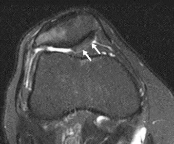 Imaging Of Patellofemoral Disorders Clinical Radiology