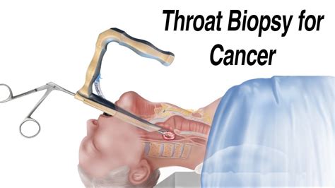 How A Throat Biopsy Is Performed To Check For Throat Cancer Youtube