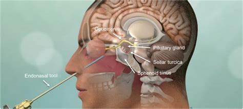 Endoscopic Endonasal Transsphenoidal Approach ²⁰ Used With Permission