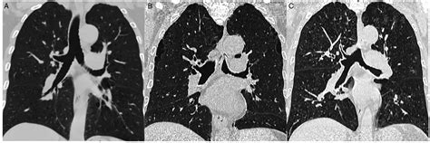 Computed Tomography Identified Phenotypes Of Small Airway Obstructions